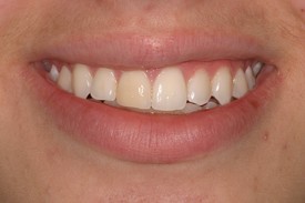 Veneer to alter color on dark teeth